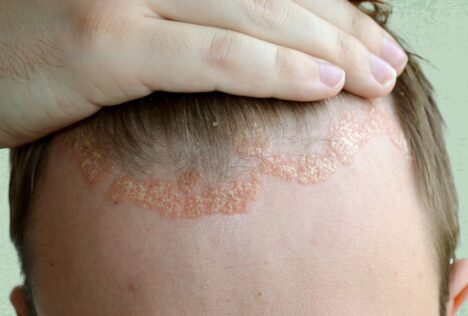 fda-approves-roflumilast-for-scalp-eczema-1440x810