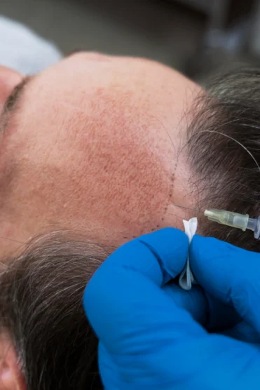 man-getting-hair-loss-treatment-prp-dermatology