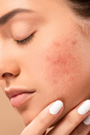 niagara-dermatology-centre-acne-treatment-intro